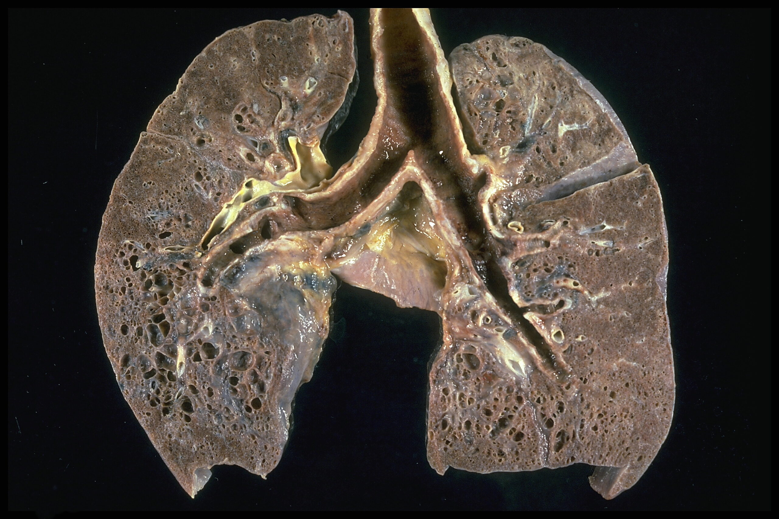 Sarcoidosis