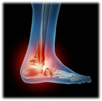 Ankle Sprains