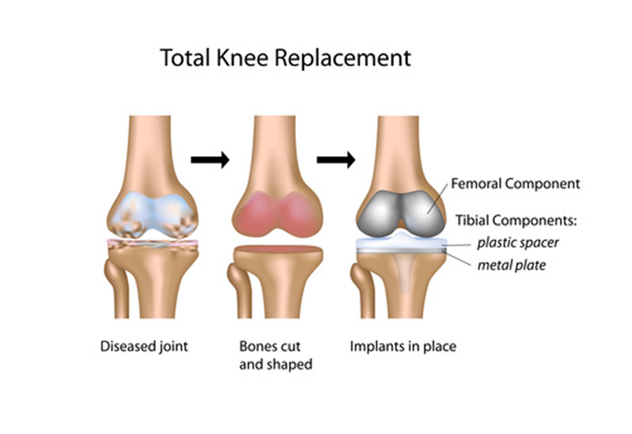 Knee Replacement Surgery Recovery Explained   Not Ready For Knee Replacement 