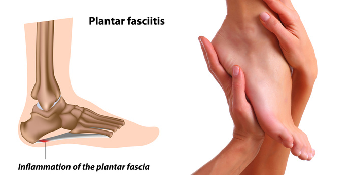Plantar fasciitis