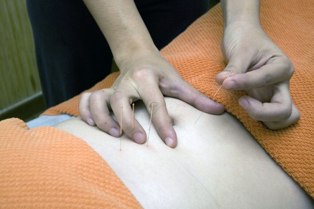 What are myofascial trigger points