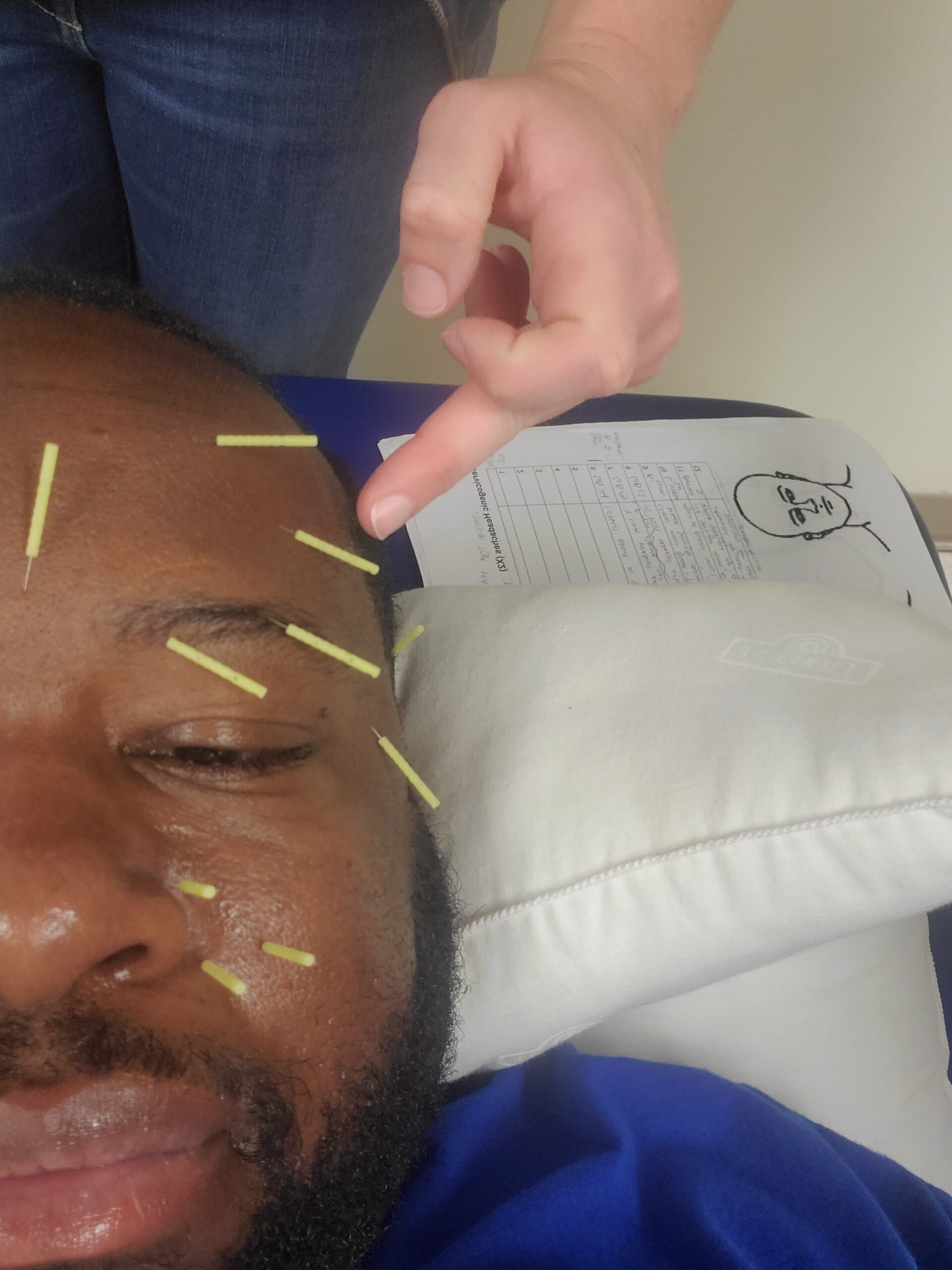 Can Dry Needling Help with Neurological Conditions?