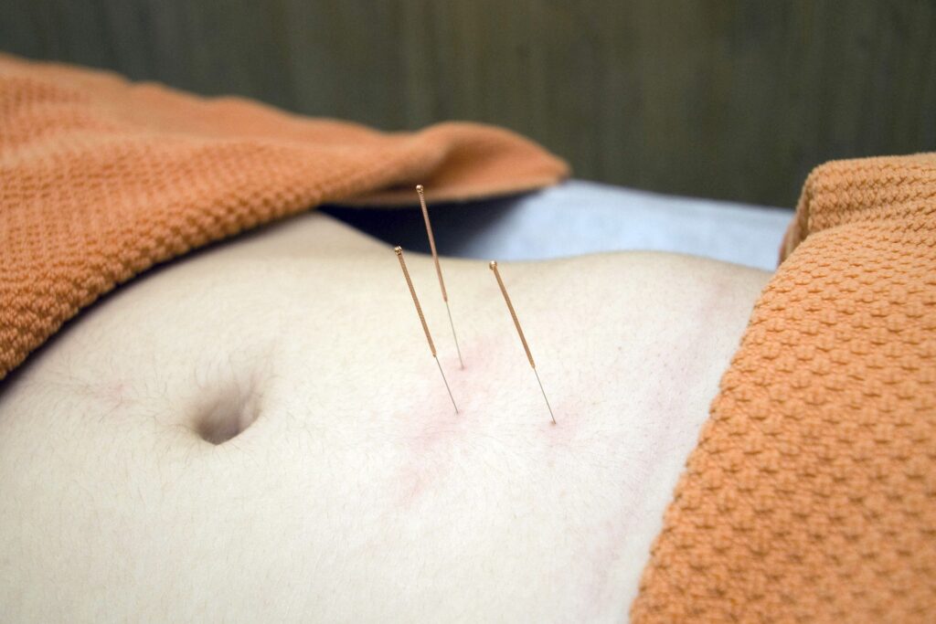 What is the difference between dry needling and acupuncture