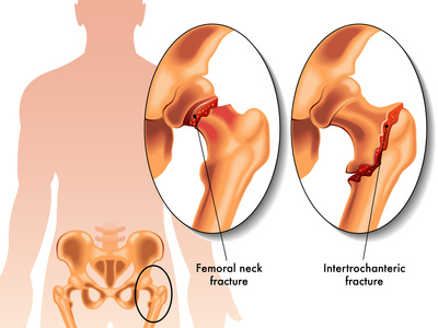 Never Ignore Hip and Thigh Pain