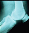 Learn About Your Arthritis Pain