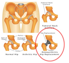 PRE AND POST-OPERATIVE PHYSICAL THERAPY FOR TOTAL HIP REPLACEMENT