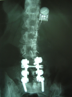 spine x-ray