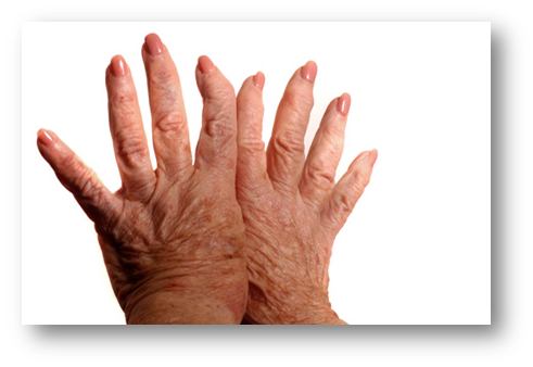 Scleroderma and Physical Therapy